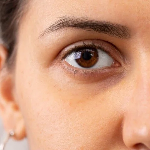 Blancamiento de ojeras